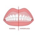 Gingival hyperplasia.